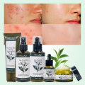 Tea Tree Anti Acne Kit Acne Treatment Set